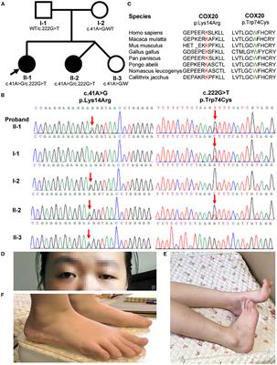 Compound Heterozygous COX20 Variants Impair the Function of Mitochondrial Complex IV to Cause a Syndrome Involving Ophthalmoplegia and Visual Failure